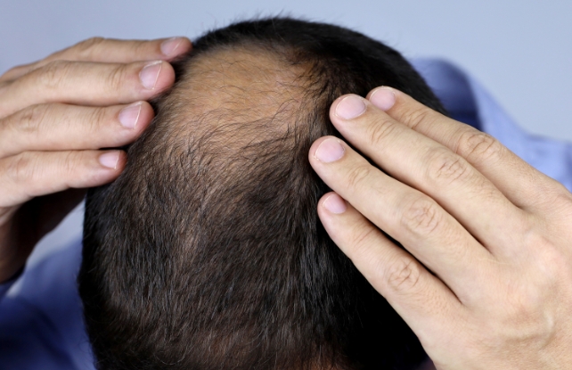 male pattern baldness