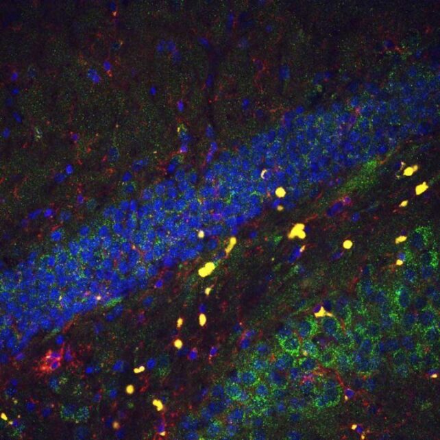 Female Sex Chromosomes May Explain Why Some Brains Age Slower