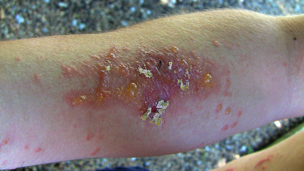 How To Get Rid Of Poison Ivy Oil On Skin