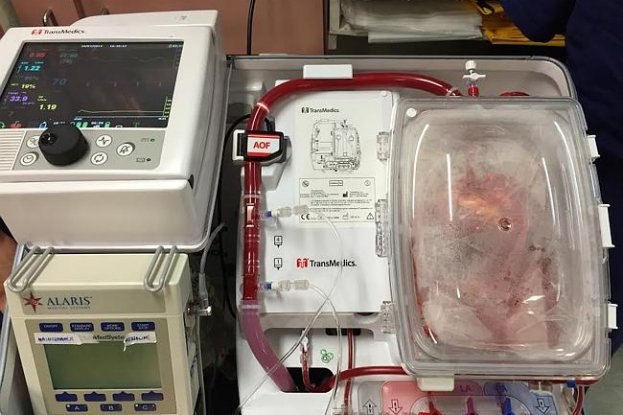 World First “dead Heart” Successfully Transplanted At Australian Hospital