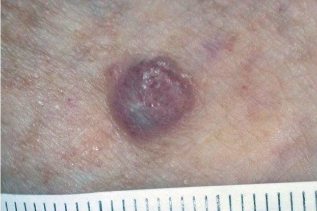 New Drug Helps Patients With Melanoma Live 