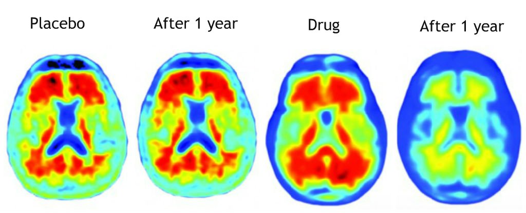 New Alzheimer's Drug Trial Clears Toxic Brain Proteins And Slows Memory ...