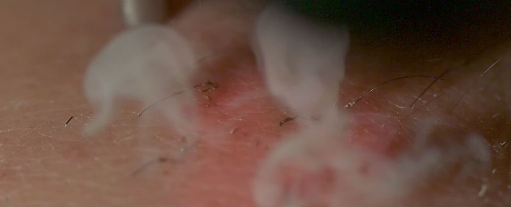 Watch The Science Of Laser Hair Removal In Slow Motion