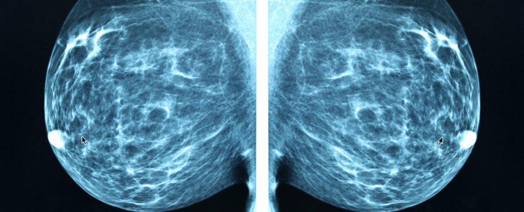 Scientists May Have Found a Way to Stop Breast Cancer ...